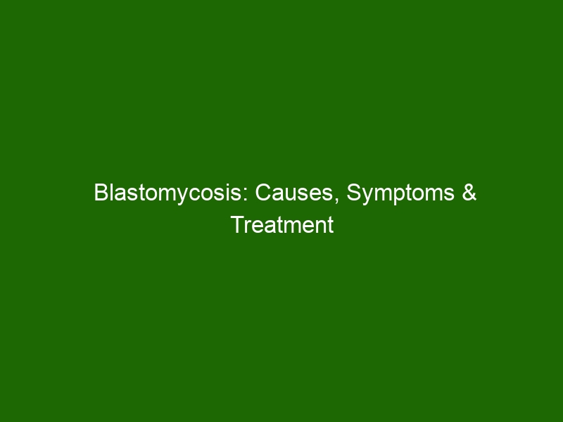 Blastomycosis Causes Symptoms And Treatment Health And Beauty 