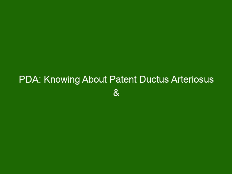 PDA: Knowing About Patent Ductus Arteriosus & Treatments Available ...