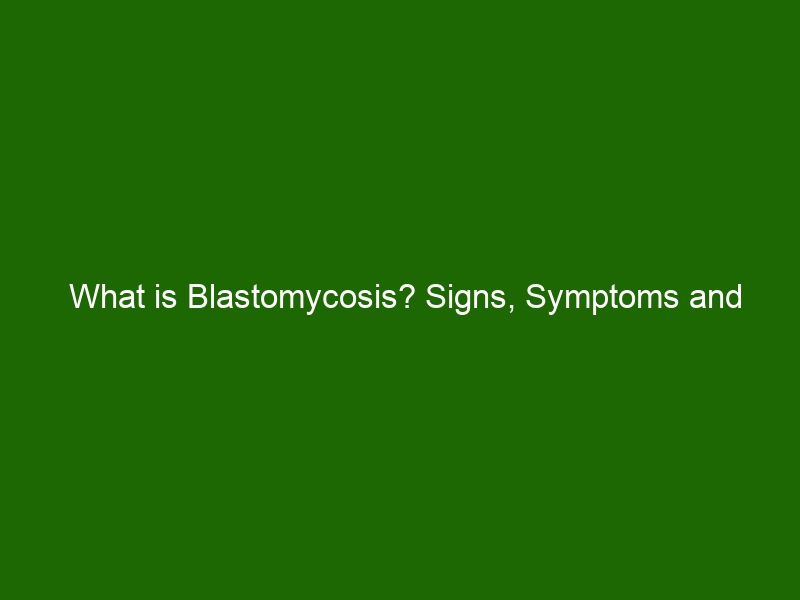 What Is Blastomycosis Signs Symptoms And Treatment Health And Beauty 