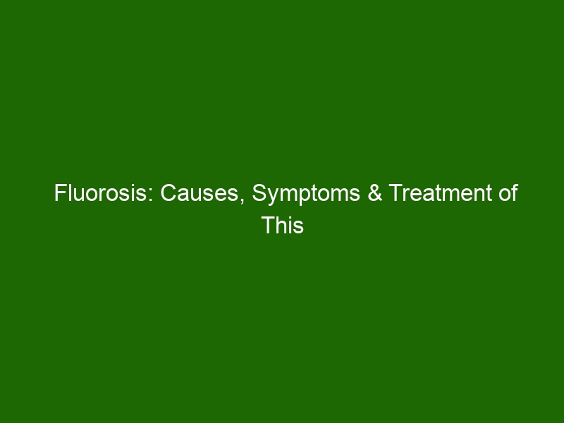 Fluorosis: Causes, Symptoms & Treatment Of This Dental Condition ...