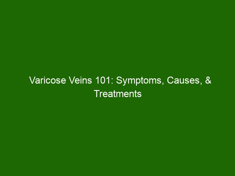 Varicose Veins 101: Symptoms, Causes, & Treatments - Health And Beauty