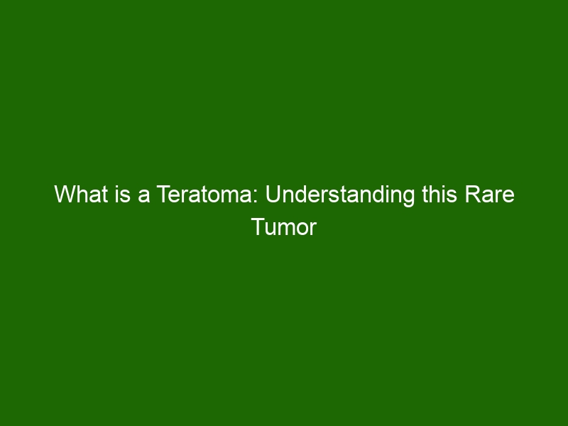 What Is A Teratoma Understanding This Rare Tumor And Its Treatment