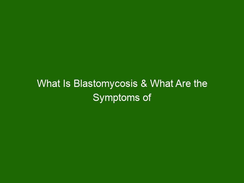 What Is Blastomycosis And What Are The Symptoms Of This Infection Health And Beauty 